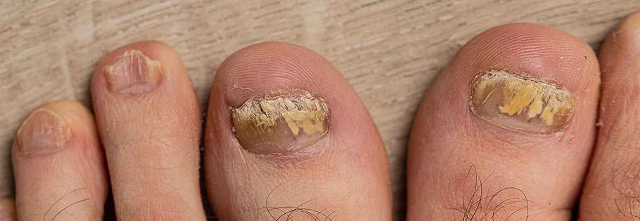 Toenail Fungus Treatment – Podiatry Instruments | Blizzard