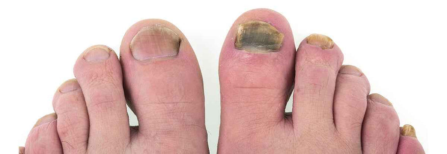Foot Infection Symptoms & Treatment - Podiatry Instruments | Blizzard