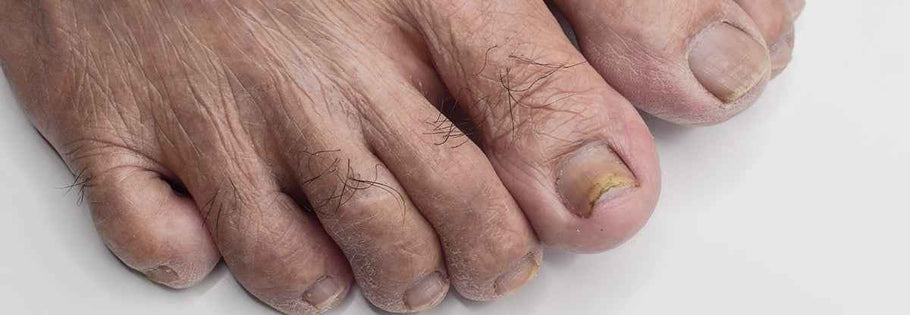 Thick Toenails Causes & Care - Podiatry Instruments | Blizzard