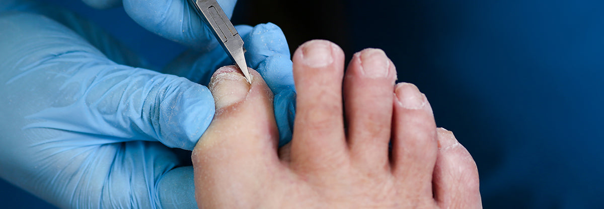 What Causes Ingrown Toenails? - Simple Common-Sense Prevention – Blizzard