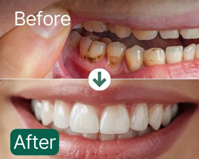 Before and after comparison of teeth with dental treatment